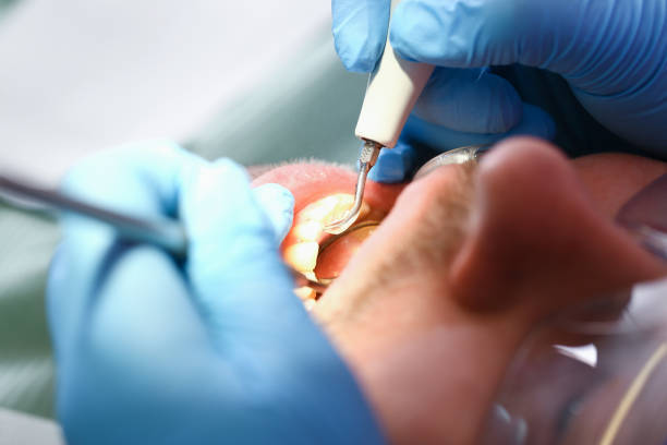 Best Dentist for Tooth Abscess  in Oakton, VA